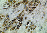 Immunohistochemische Untersuchung von TßRII in Brustgewebe.