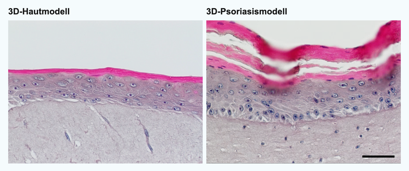 3D-In-vitro-Psoriasismodell. Man erkennt die für die Krankheit typische gestörte Verhornung (pink) und Verdickung (Akanthose) der Epidermis. Balken = 75 µm