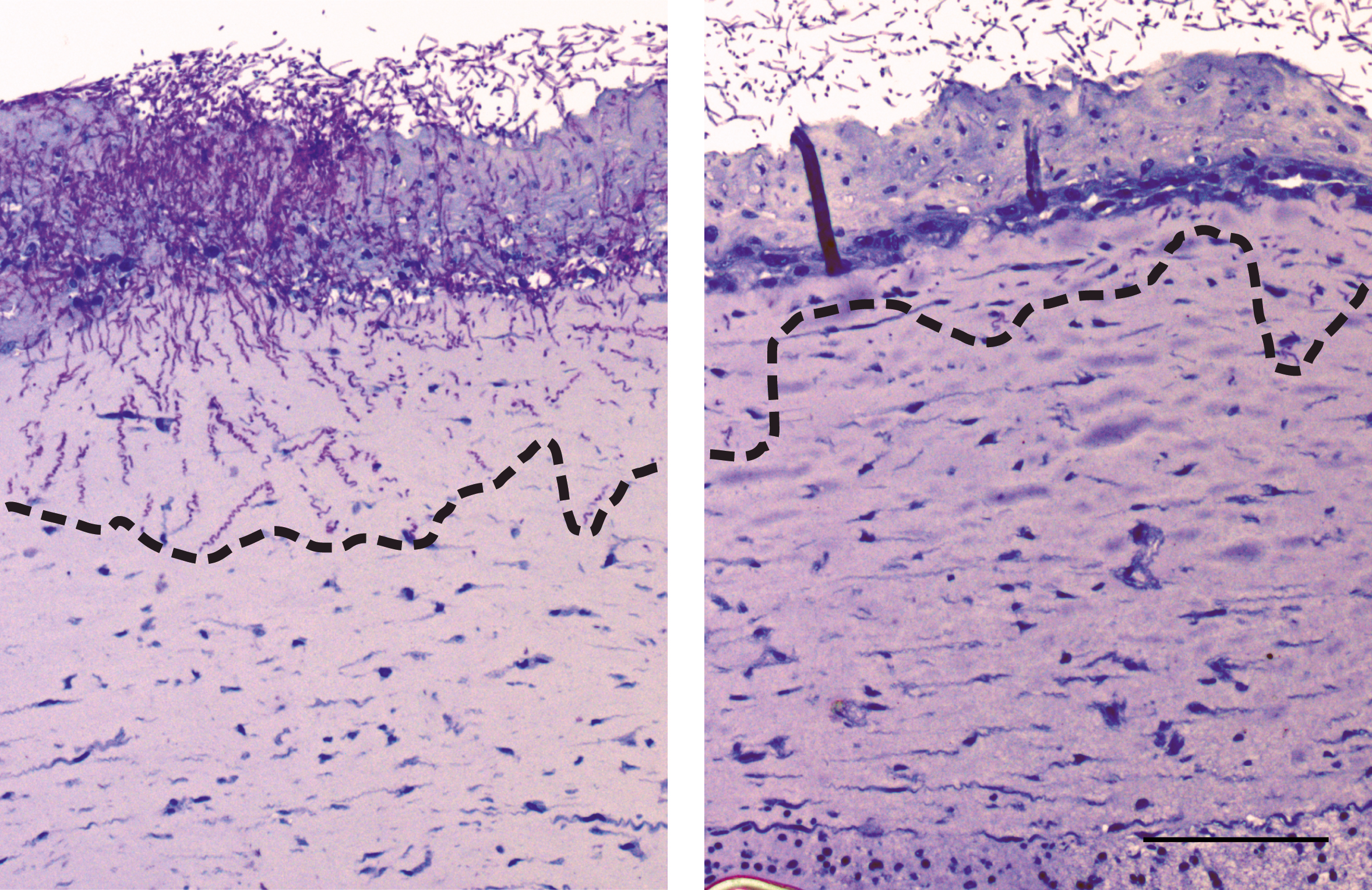 Infektion von Hautmodellen mit C. albicans in der Anwesenheit (rechts) und Abwesen­heit (links) von Immunzellen.