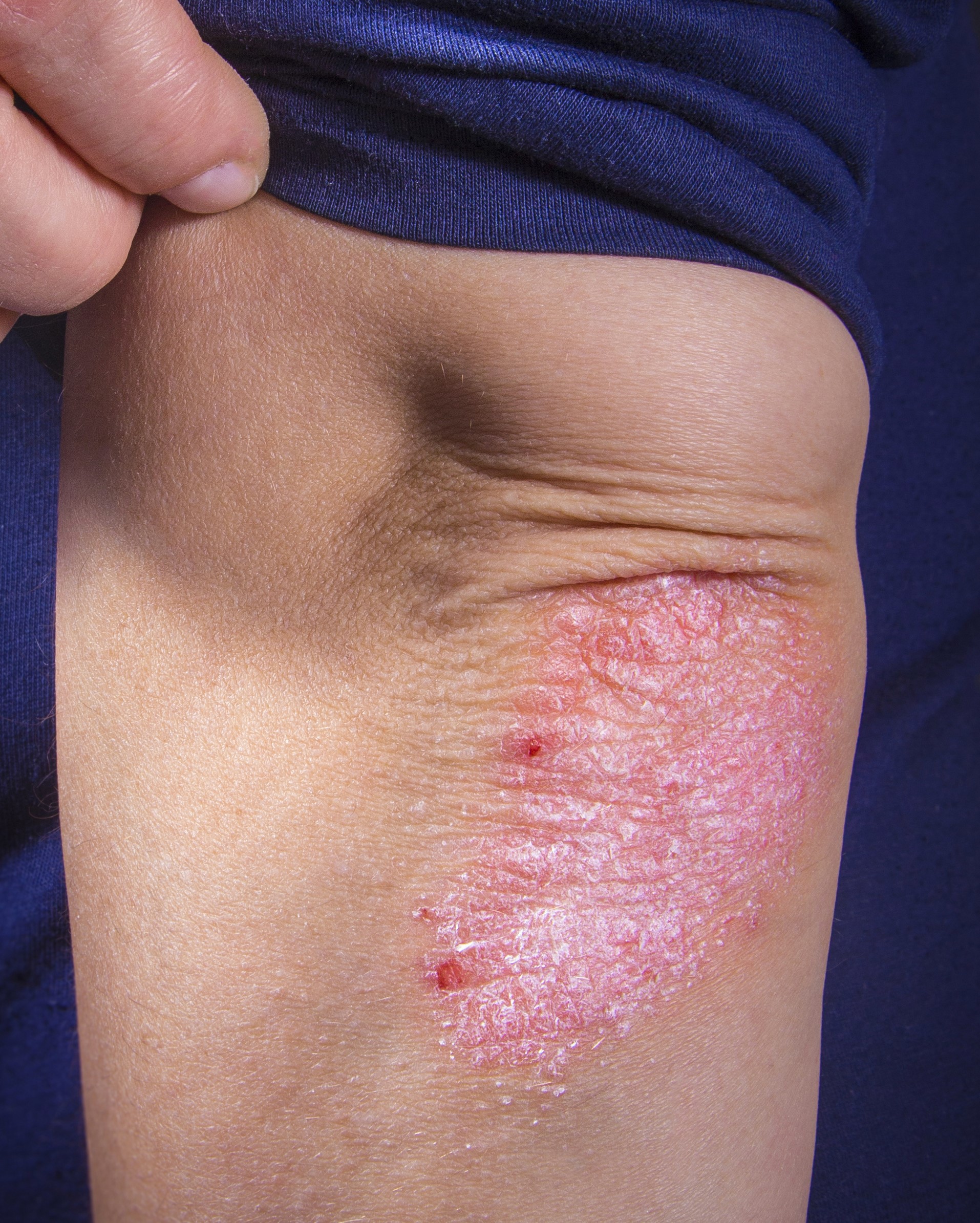 Reddish, inflamed plaques in a psoriasis patient. Reddish, inflamed plaques in a psoriasis patient.